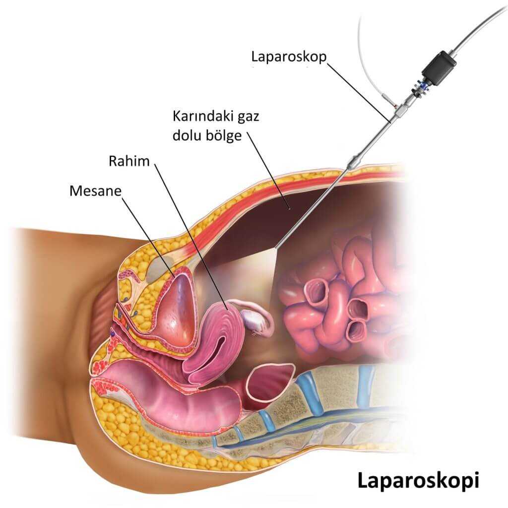laparoskopi nasıl yapılır?